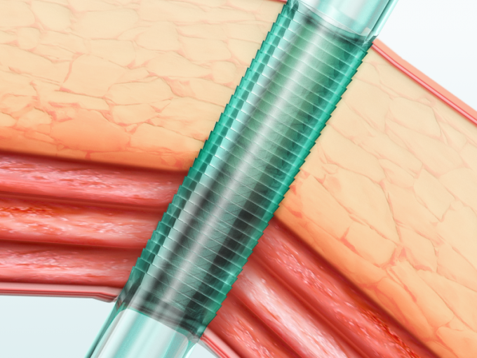 Trocar e cannula ottici eliminabili sterili per paziente della chirurgia della laparoscopia il singolo 0