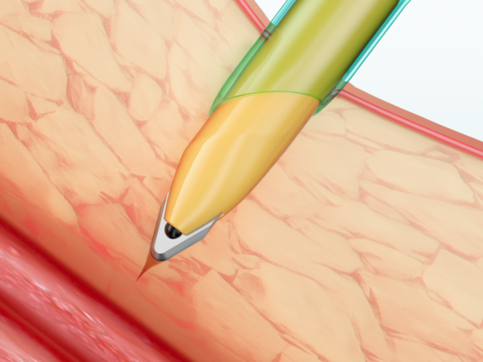Cannula eliminabile di trocar degli strumenti laparoscopici con la lama 1