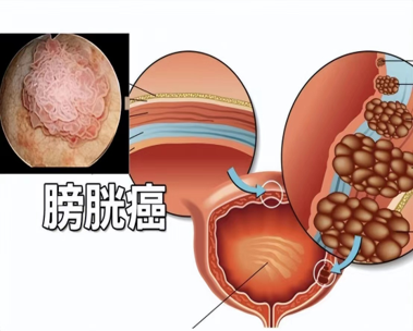 ultime notizie sull'azienda Diagnosi clinica e cura fisiologica del cancro alla vescica.  0